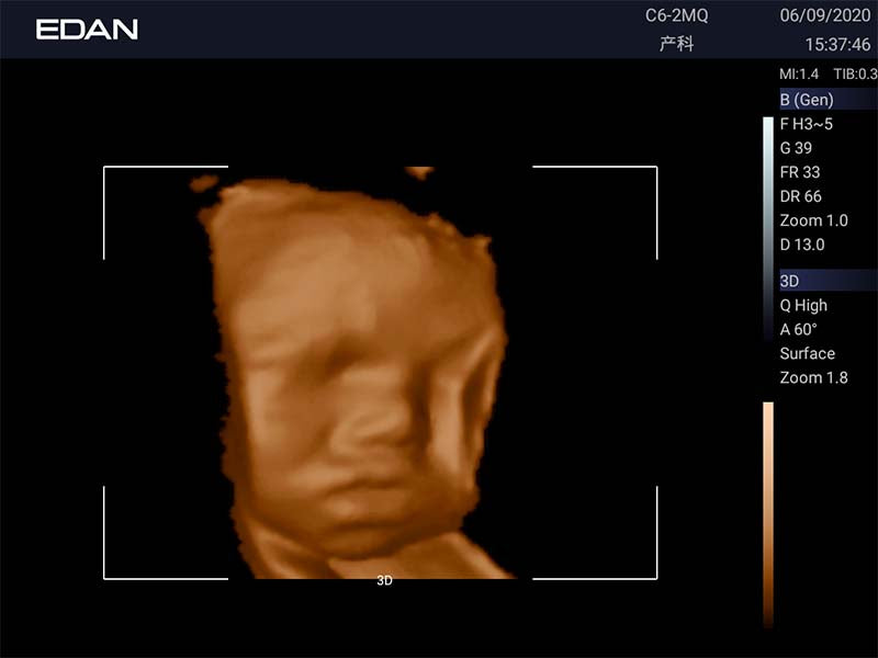 Edan Acclarix LX3 Cart-Based Color Doppler Ultrasound